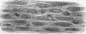 From deeper part of a granulating wound fepmdle shaped cells with occasional leucocytes are shown.
