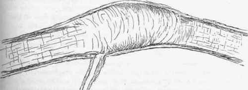 Fusiform miliary aneurysm, x 27.