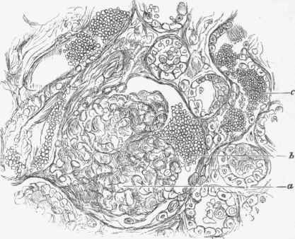 Haemorrhage from a Malpighian tuft in a case of scarlet fever.