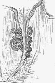 Hair in its follicle with sebaceous gland, from wall of same cyst as the former figure, x '20.