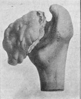 Head of femur in chronic rheumatic arthritis   the head and neck worn down and the appearance of a new head produced by new formation.