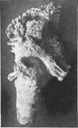 Heads of ulna and radius from tuberculosis of elbow.