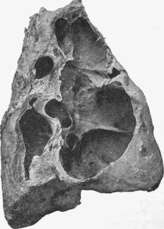 Healed cavities in lung.