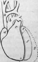 Hypertrophy of left ventricle.