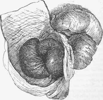 Intussusception. The colon is laid open and several coils of ileum are shown.