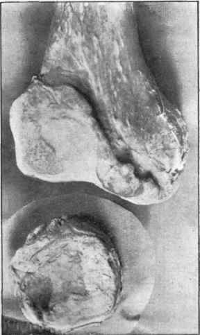 Lower end of femur and patella in chronic rheumatic arthritis.