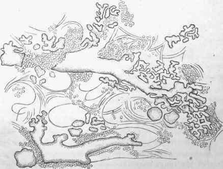 Oil or fat embolism of lung.