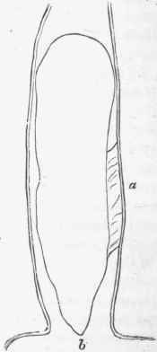 Polypoid myoma of oesophagus in section, and semi diagrammatic.