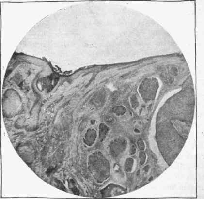 Rodent ulcer. To the left the normal skin structures, including part of a hair follicle and sebaceous gland.
