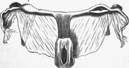 Rudimentary uterus. (Graily Hewitt from Kussmaul).