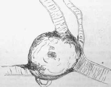 Sacculated miliary aneurysm of a nutrient artery of the brain.