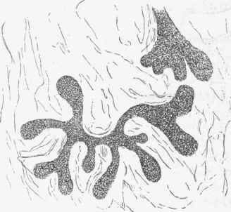 Section of an adenoma of mamma.