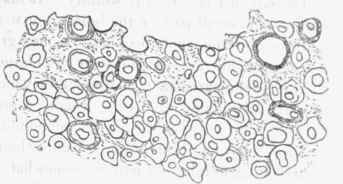 Section of cartilaginous part of a tumour of mamma which contained besides spindle celled and fibrous tissue, x 200.
