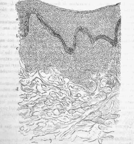 Section of skin in frainbcesia, from a part where the disease was not very far advanced.