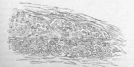 Transverse section of a neuroma.