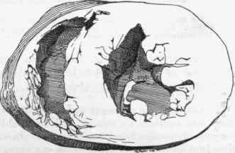 Transverse section of ventricles of heart showing hypertrophy of the left, from a case of chronic Bright's disease.
