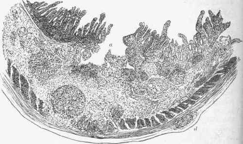 Tubercular ulcer of intestine.