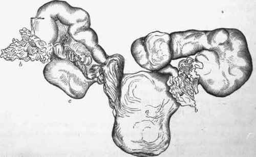 Tuberculosis of Fallopian tubes seen from behind, a, uterus; 6,6, fimbriated extremities of the tubes; c, left ovary.