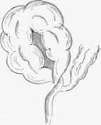 Twisting of the .sigmoid flexure.