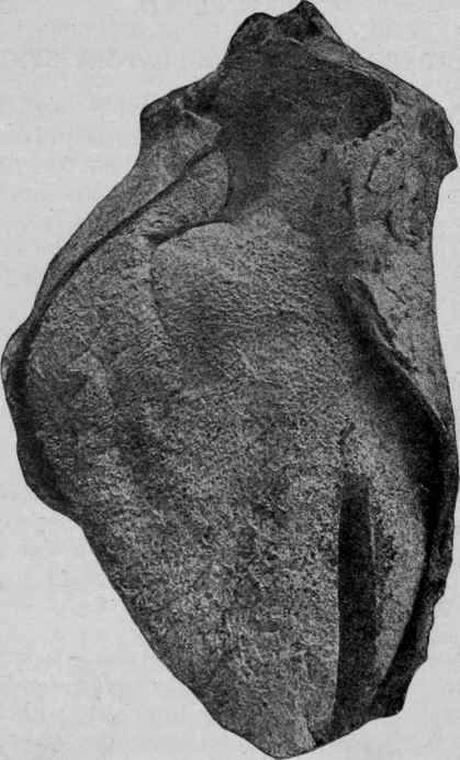 Acute Pericarditis (Bramwell).