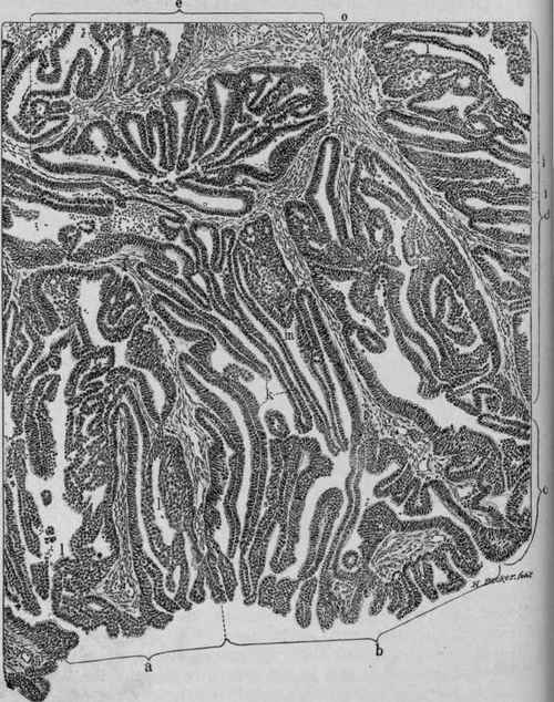 Adenocarcinoma of the Body of the Uterus (Cullen).