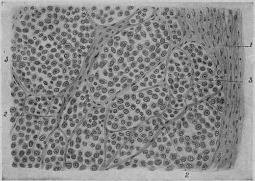 Alveolar Large Round celled Sarcoma from the Periosteum. X 250 (D�rck).