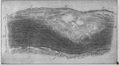 An Atheromatous Patch in the Abdominal Aorta which Has Not Yet Broken Through (Dmitrijeff).