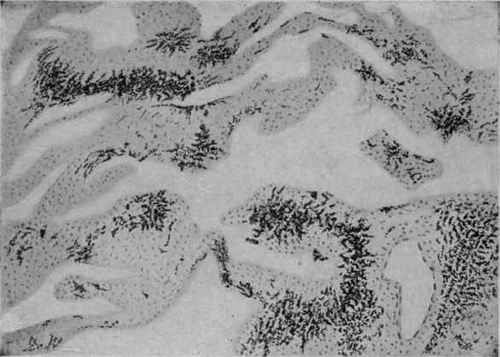 Anthracosis of the Lung. X 100 (D�rck).