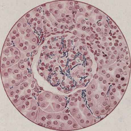Anthrax Bacilli in Glomeruli of Kidney (McFarland).