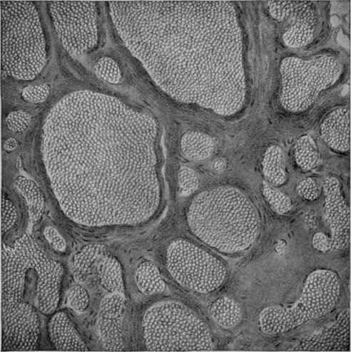 Cavernous Angioma (Warren).