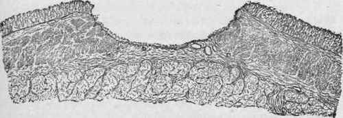 Chronic Ulcer of the Stomach, Showing a Section Through the Stomach Wall.
