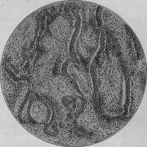 Endothelioma of the Pleura. Zeiss, Oc. 2; ob. c.