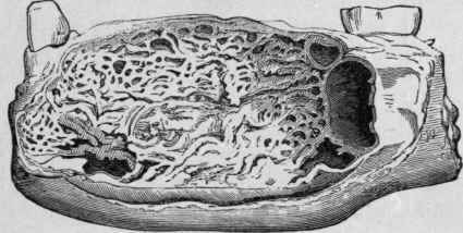 Epithelial Odontoma. Natural Size (Bland Sutton).