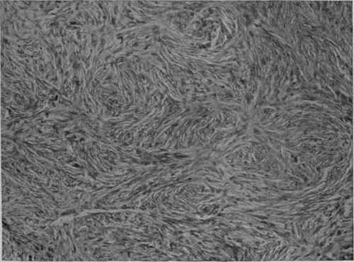 Fibroma. Cells and Fibrils in Small Bundles which Run in Every Direction (Mallory).
