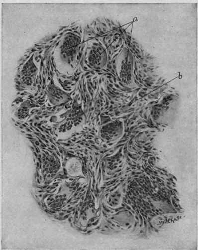 Giant cell Sarcoma of the Thigh (McFarland). a, Giant cells; b, spindle cells.