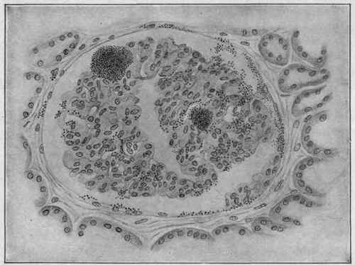 Infectious Embolism of the Kidney Following Endocarditis and Showing Groups of Staphylococci in a Glomerulus (D�rck).