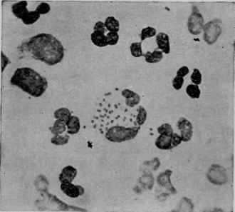 Meningococcus in Spinal Fluid (from Hiss and Zinsser, Text Book of Bacteriology, D. Appleton & Co., Publishers).