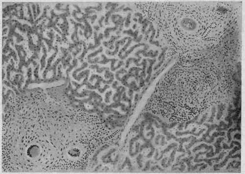 Miliary Tuberculosis of the Liver. X 70 (D�rck).