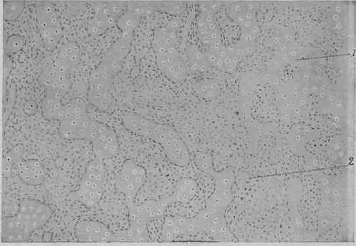 Osteoma of the Lung. X 75 (D�rck).