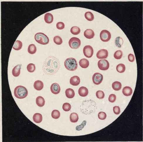 PLATE II. Malarial Parasites in Blood (Grawitz).