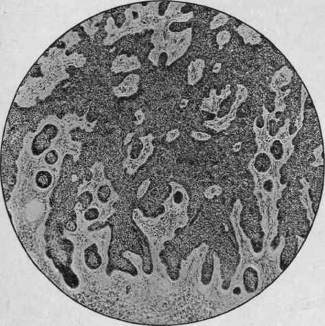 Rodent Ulcer (Mallory).