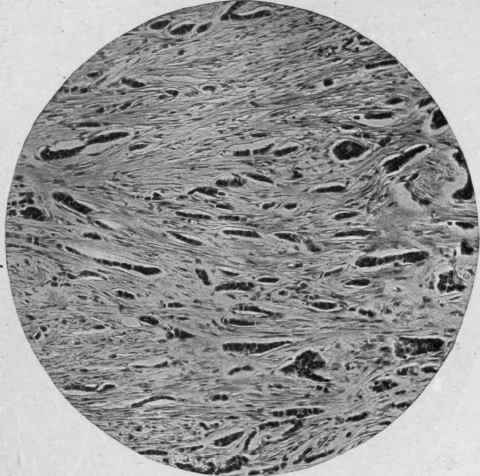Scirrhous Carcinoma of Breast (Mallory). Alveoli of epithelial cells small; stroma abundant.