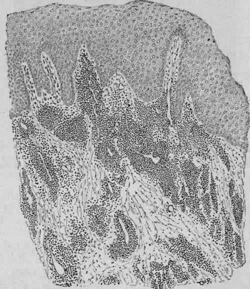Section from a Primary Syphilitic Nodule of the Mucous Membrane of the Mouth.