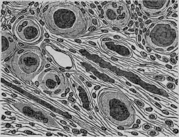 Section of a Psammoma of the Dura Mater. X 200 (Ziegler).