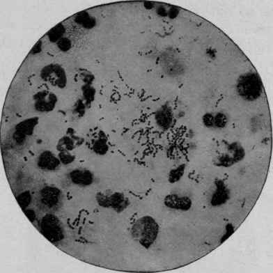 Streptococcus Pyogenes, from the Pus taken from an Abscess. X 1000 (Fr�nkel and Pfeiffer).