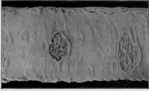 Tuberculous Ulceration of the Intestine (Stengel).