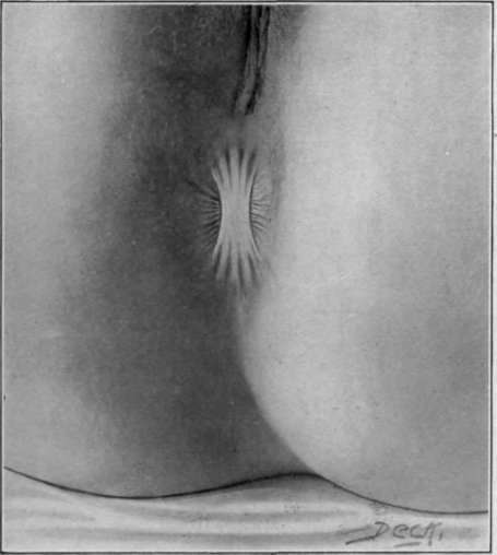 Fig. 12. Membranous occlusion of the anus.