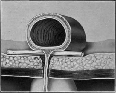 Fig. 22. Colostomy. Cross section Madly Reclus method.