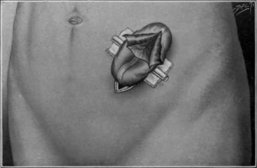 Fig. 23. TittleÃ¢s incision for opening the gut for temporary inguinal colostomy.