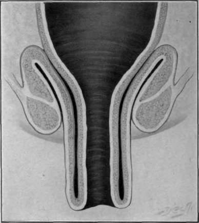 Fig. 29. Complete rectal prolapse, second degree or bilateral, a discharge of mucus, often loss of control of the sphincters, increased frequency of parturition and bowel movements, and there may be hemorrhage, and a dragging sensation.